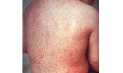 Measles outbreak in UP village, three children die